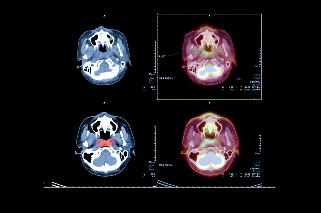 Results Of PET/CT Scan Of The Brain